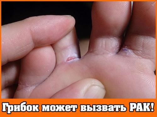 Грибок стоп и ногтей - признак скорой смерти!