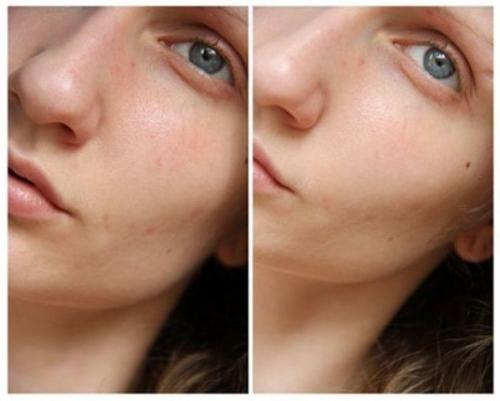 Глубокая чистка лица за 1 процедуру! Глубокая чистка лица за 1 процедуру!