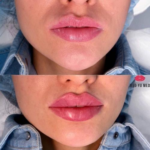 Лишь в том случае, если мастер хороший, то могут получиться красивые губки! 02