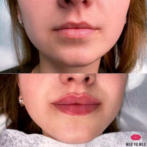 Лишь в том случае, если мастер хороший, то могут получиться красивые губки! 03