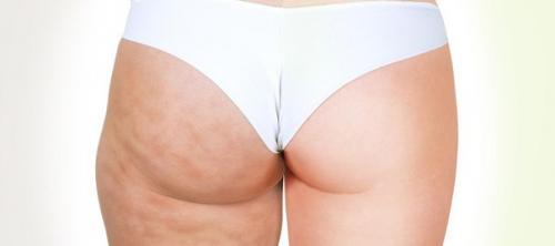 5 советов для быстрого избавления от целлюлита.