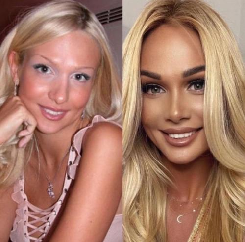 Российские знаменитости до и после пластики. 05