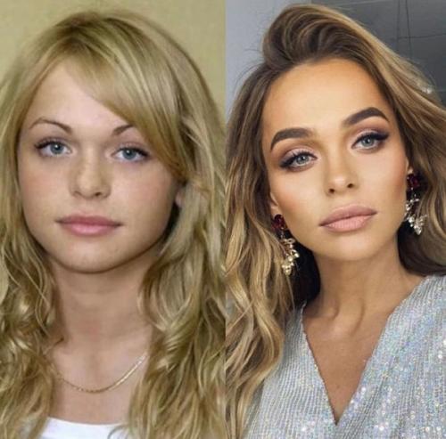 Российские знаменитости до и после пластики. 08