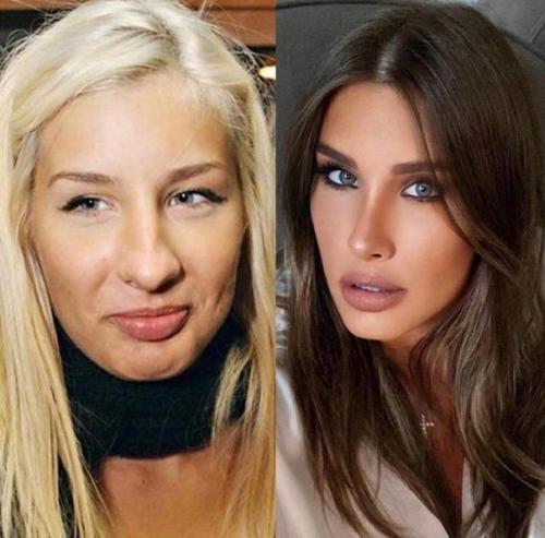 Российские знаменитости до и после пластики. 03