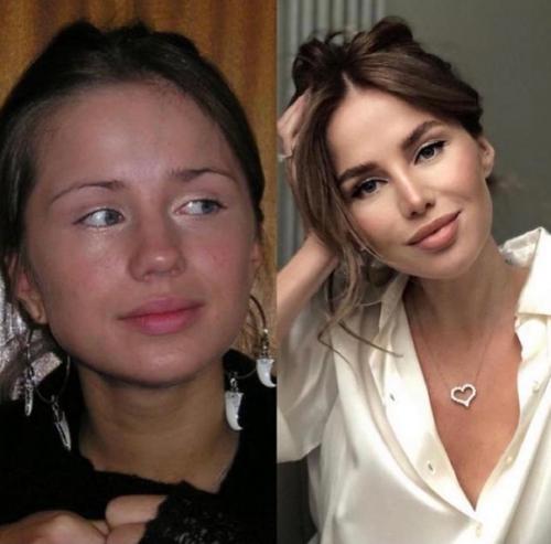 Российские знаменитости до и после пластики. 04