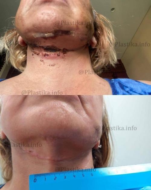 Маме виктории бони изуродовал лицо пластический хирург. 02