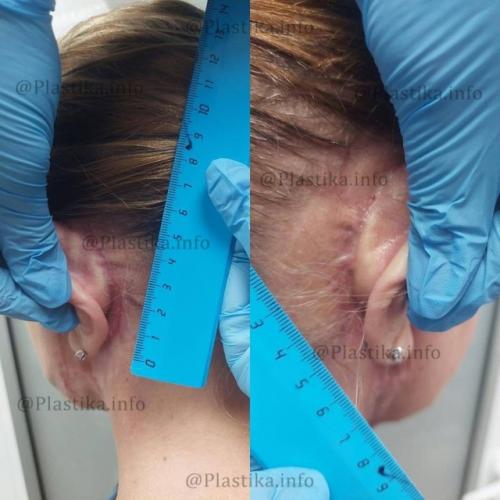 Маме виктории бони изуродовал лицо пластический хирург. 03