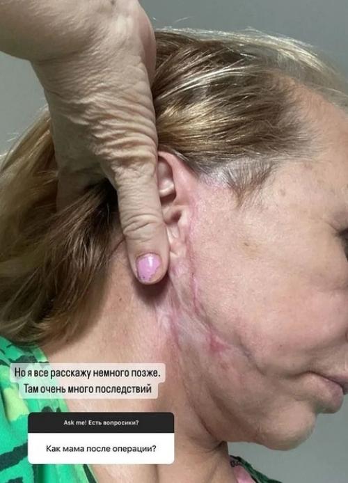 Маме виктории бони изуродовал лицо пластический хирург. 01