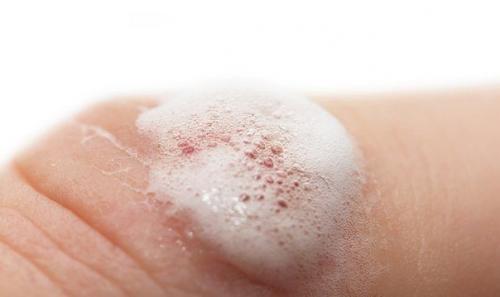 Перекись водорода обязательно должна быть в вашей домашней аптечке!