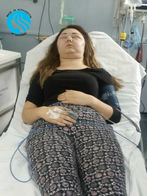 Лицо девушки опухло до невероятных размеров после того, как ей покрасили волосы. 02 Лицо девушки опухло до невероятных размеров после того, как ей покрасили волосы. 02