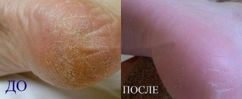 Этот очень хороший рецепт поможет тем, у кого шершавые руки, трещины на пятках, натоптыши, ногти на ногах 