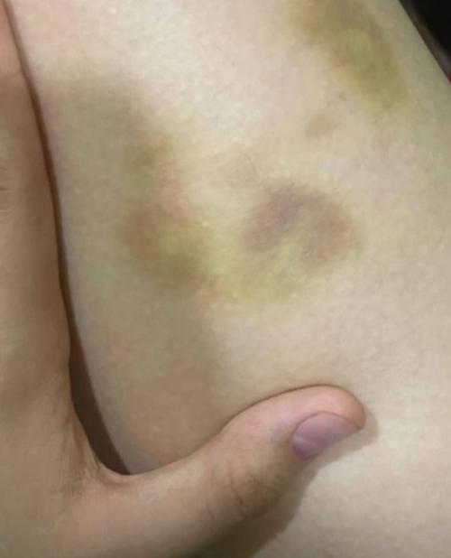 15-Летнюю Дашу суднишникову, беременную вторым ребенком, избили. 01