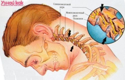 Что делать, если болит шея.

