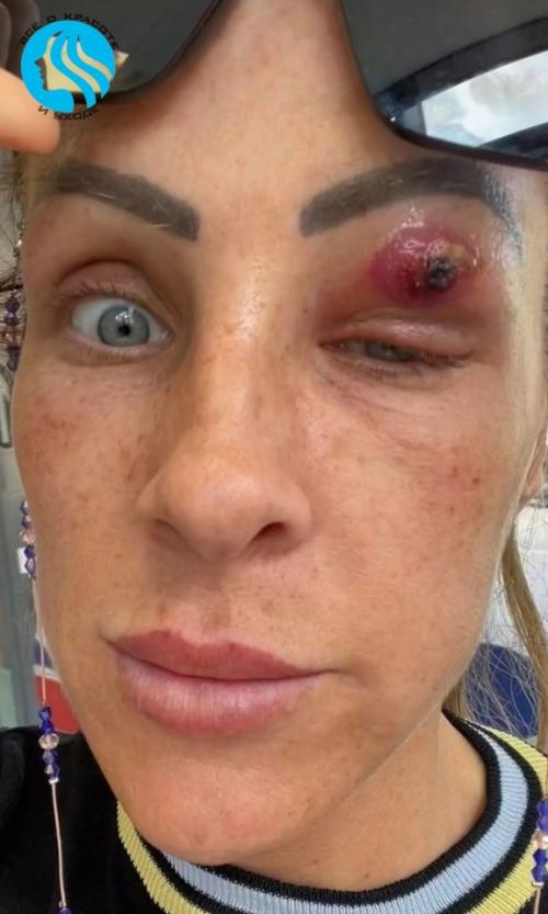 Однажды утром женщина обнаружила на правом веке прыщ, который, как ей показалось, начал увеличиваться в размерах. 
