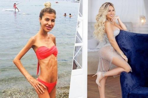 Маша кохно поборола анорексию! 03