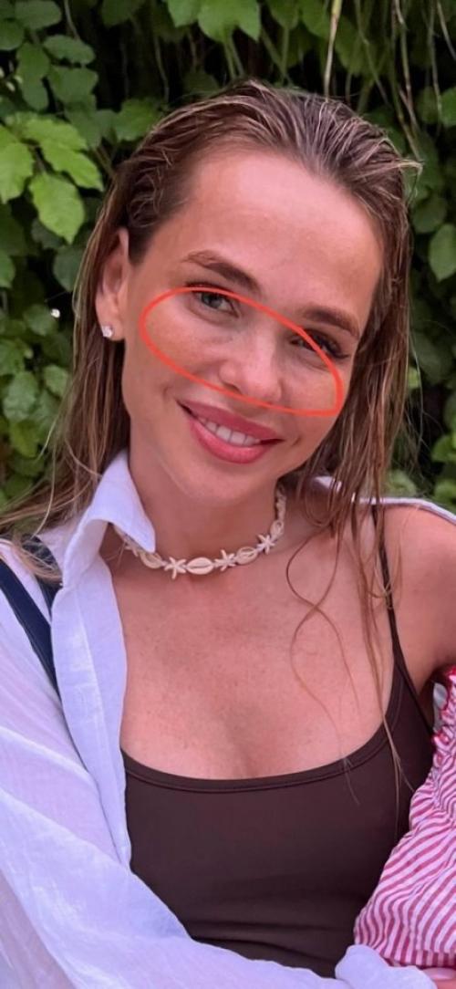 Анна хилькевич рассказала, что пожалела об уколе красоты: Препарат Начал Сползать Вниз. 01