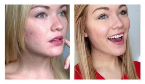 Мечтаете о чистом лице без угрей, акне и пятен? Мечтаете о чистом лице без угрей, акне и пятен?