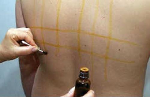 Йодовая сетка: целебные свойства простых линий.