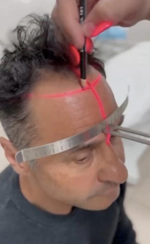 Стас костюшкин раскрыл истинную причину почему он побрился наголо - певец сделал пересадку волос. 01