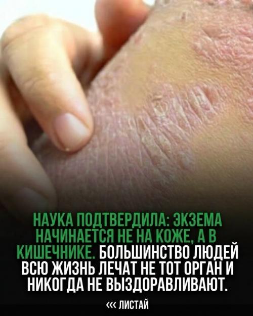 Утверждение о том, что экзема начинается в кишечнике и что люди лечат 