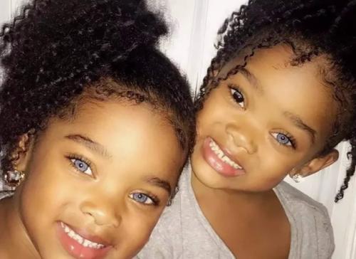 Уникальные близняшки - африканки с голубыми глазами. 02