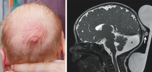 Пятинедельного мальчика привели на обследование по поводу болезненной шишки на коже головы, которая присутствовала с рождения.  