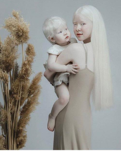 Дети - альбиносы это такая прелесть, правда?