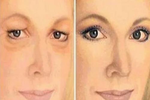 Нависшие веки?  Как их поднять? Нависшие веки?  Как их поднять?
