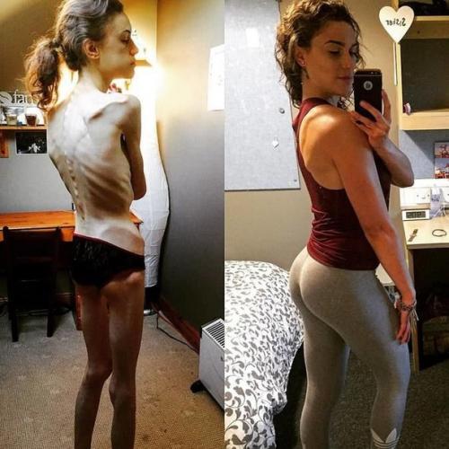 Эта девушка смогла победить анорексию, которой страдала с 15 лет. 05