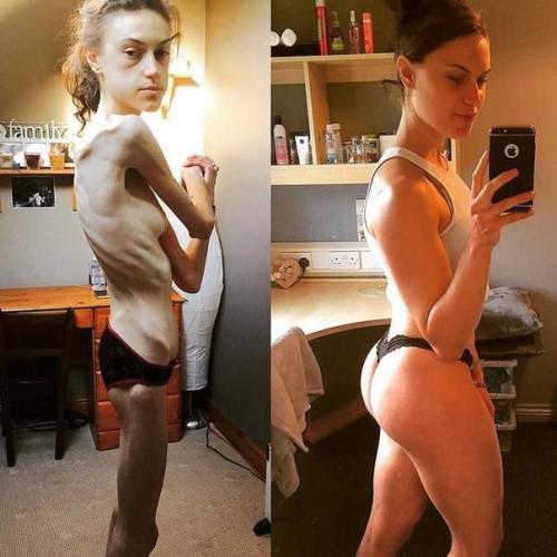 Эта девушка смогла победить анорексию, которой страдала с 15 лет. 04