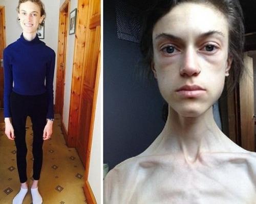 Эта девушка смогла победить анорексию, которой страдала с 15 лет.