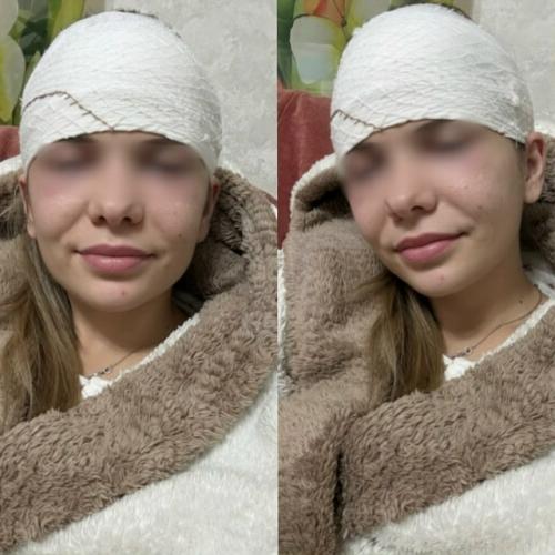 Из-за обычного прыщика россиянке разрезали лоб и положили в больницу. 01