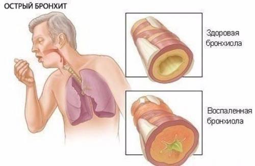 Мы лечим бронхит. Мы лечим бронхит.