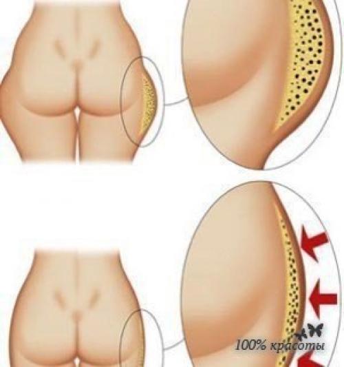 Антицеллюлитное обертывание горчицей. 01