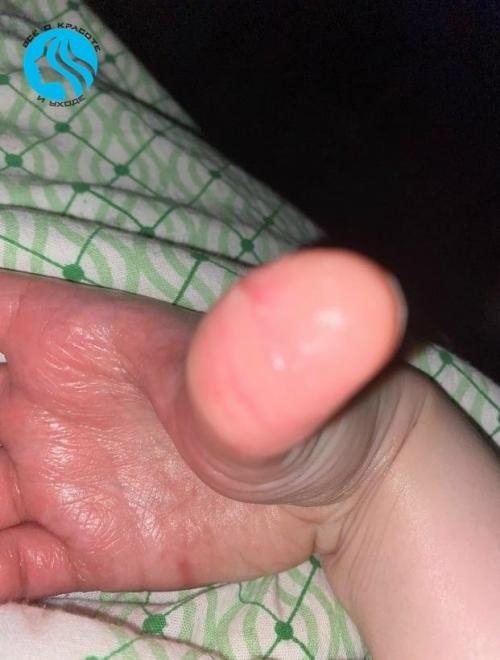 Уже три года не могу справиться с этой проблемой: кожа на руках трескается до крови, чешется, на пальцах появляются мелкие пузырьки.  