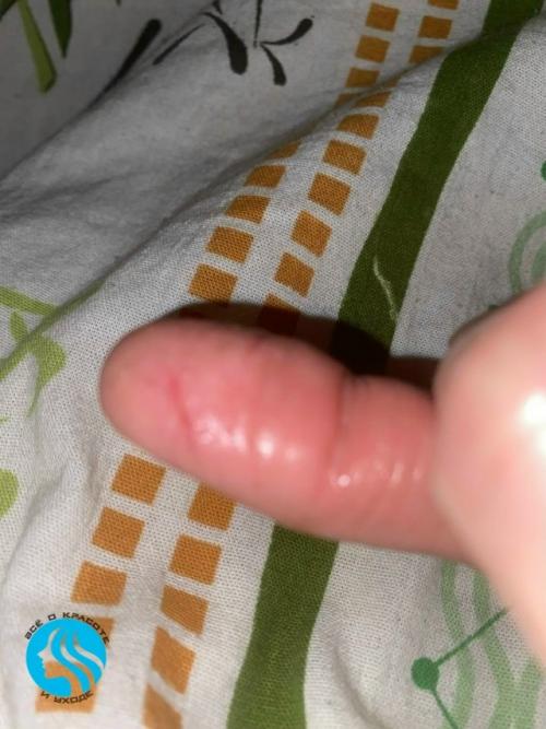 Уже три года не могу справиться с этой проблемой: кожа на руках трескается до крови, чешется, на пальцах появляются мелкие пузырьки. 01