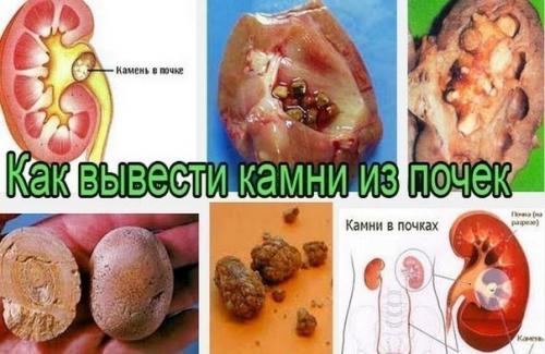 Средство от камней в почках и в желчном пузыре. Средство от камней в почках и в желчном пузыре.
