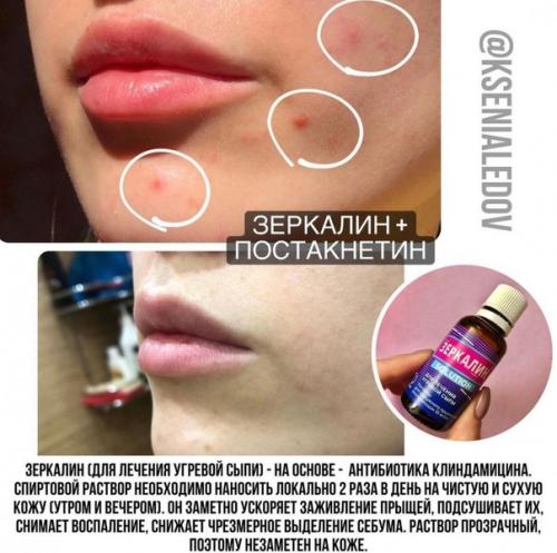 Что поможет избавиться от акне! 03