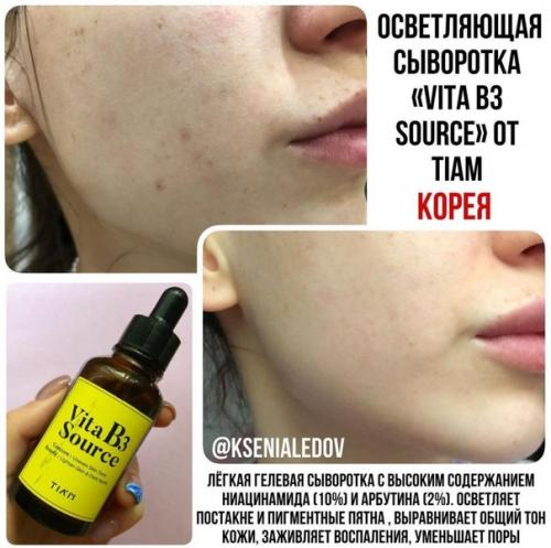 Что поможет избавиться от акне! 01