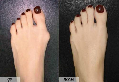 Как можно вылечить выпирающую косточку на ноге? 

