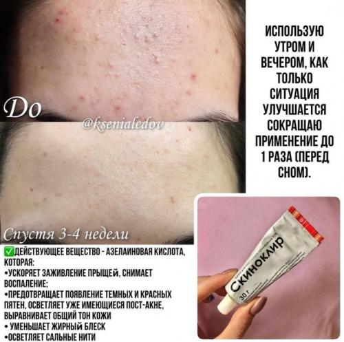 Что поможет избавиться от акне! 05