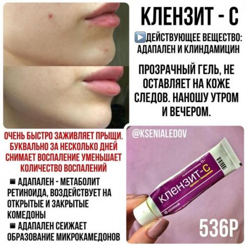 Что поможет избавиться от акне! 04