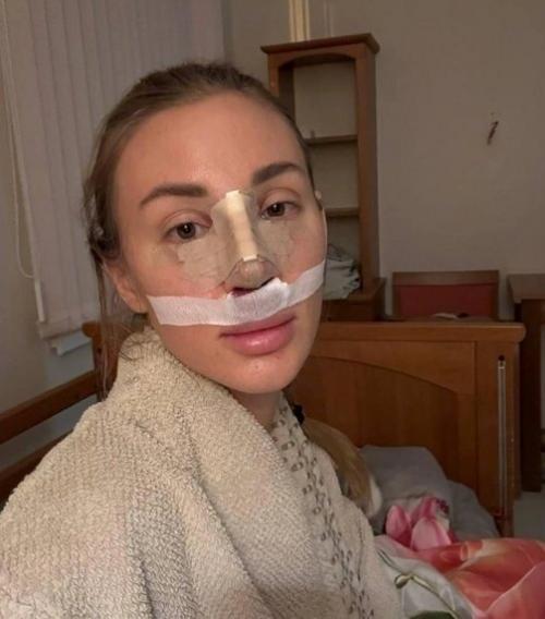 Тяжелая плата за идеальный нос: Саша Калмыкова пожалела о пластической операции из-за жуткого восстановления. 01