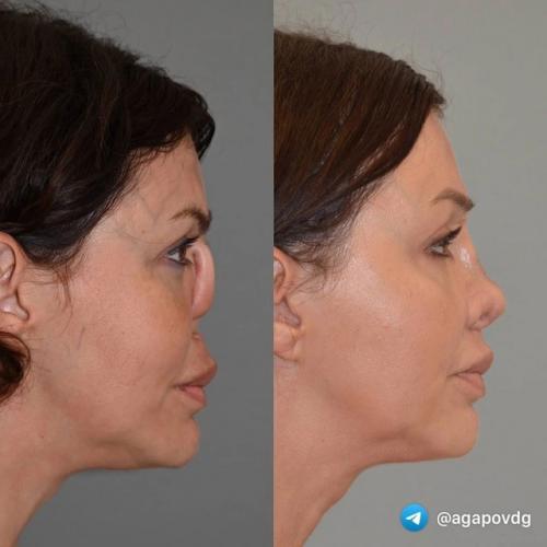 Пластический хирург, который сделал новый нос бывшей жене Аршавина Алисе Казьминой, показал страшные фотографии пациентки до операции. 02