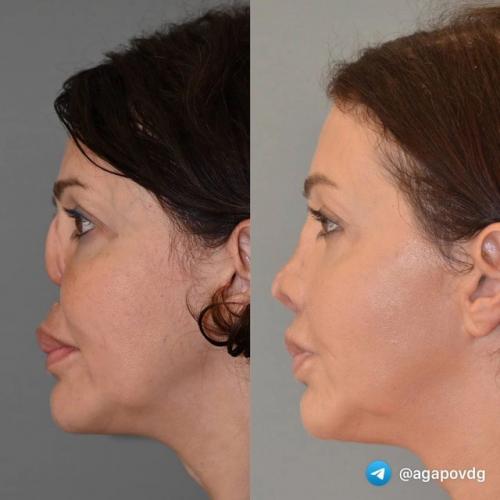 Пластический хирург, который сделал новый нос бывшей жене Аршавина Алисе Казьминой, показал страшные фотографии пациентки до операции. 01