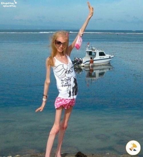 Эта девушка анорексию победила. 01