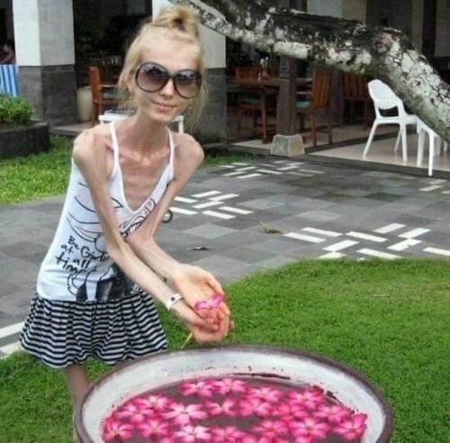 Эта девушка анорексию победила. 02