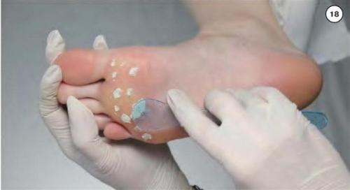 Как избавиться от мозолей и натоптышей. Как избавиться от мозолей и натоптышей.