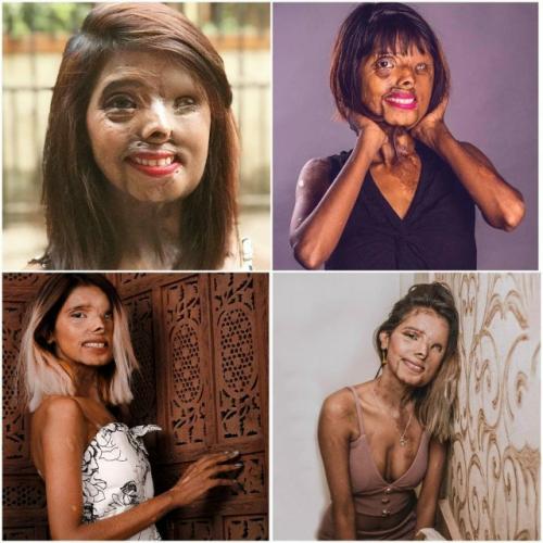 23-Летняя девушка, которую отец облил кислотой, в данный момент стремится стать моделью.  