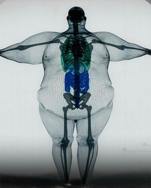 Скелет человека при ожирении практически не меняется, но сила, воздействующая на него - меняется. 01